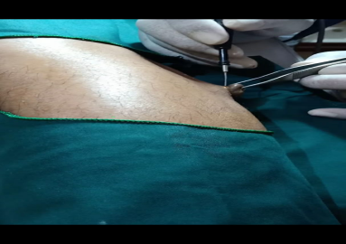 Electrosurgical Cauter