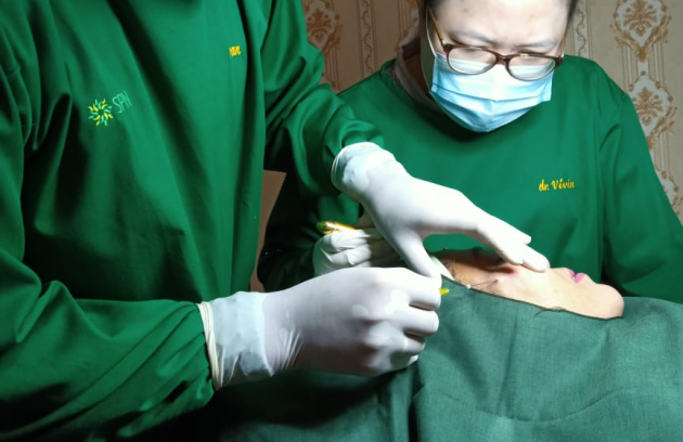 Threadlift : Tarik Benang